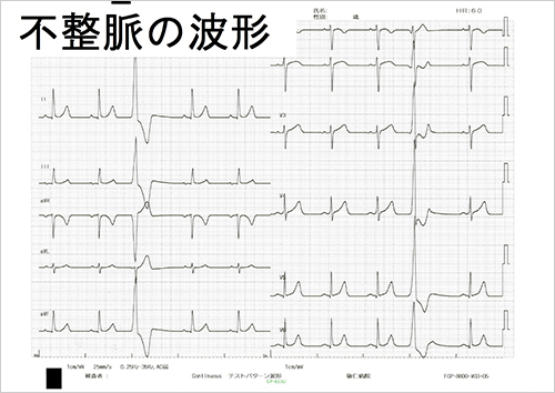 心電図検査（不整脈の波形）